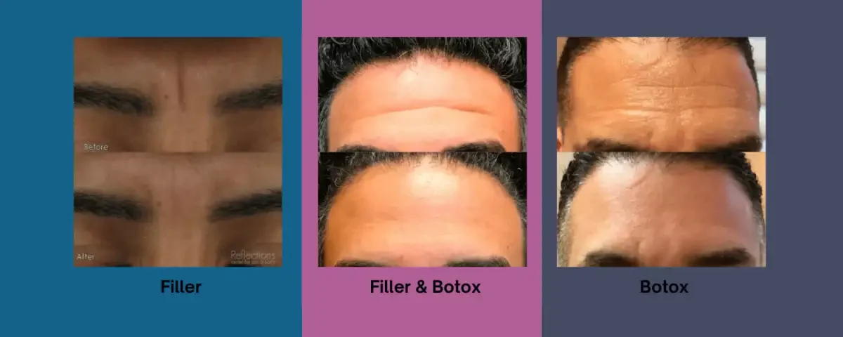 بوتاکس یا تزریق فیلر؟ کدام یک برای رفع چین و چروک صورت شما مناسب تر است؟