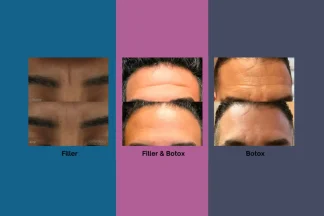 بوتاکس یا تزریق فیلر؟ کدام یک برای رفع چین و چروک صورت شما مناسب‌ تر است؟