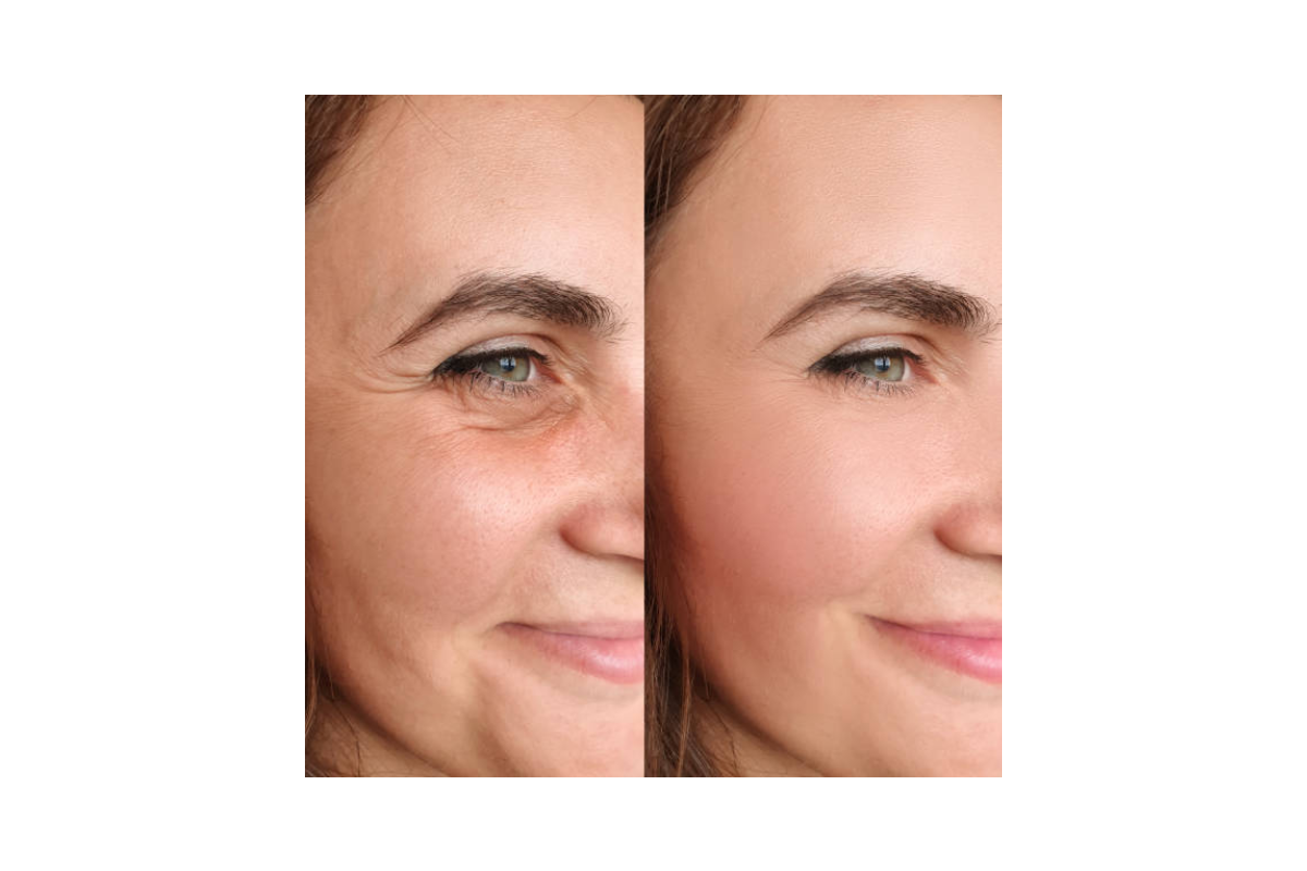 مراقبت های قبل و بعد از تزریق بوتاکس