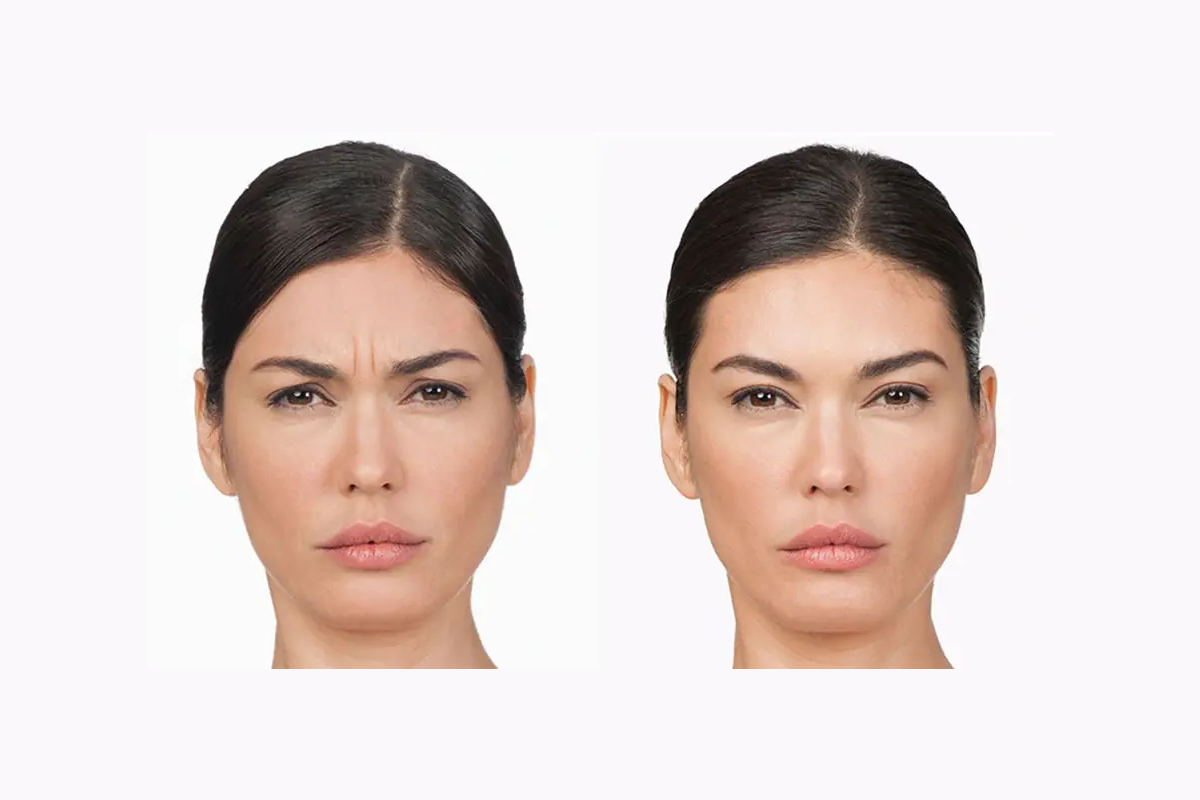 لیفت ابرو با بوتاکس چگونه در کلینیک دکتر مهدویه انجام می شود؟