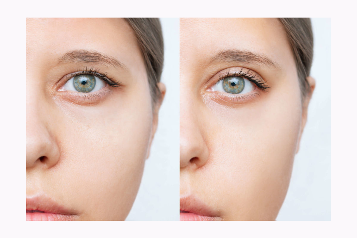 مزایای کلیدی بوتاکس ابرو که شما را شگفت زده خواهد کرد