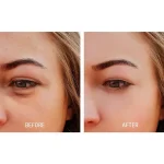 پی آر پی، راهکاری طبیعی برای رفع تیرگی و گودی زیر چشم