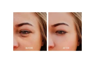 پی آر پی، راهکاری طبیعی برای رفع تیرگی و گودی زیر چشم