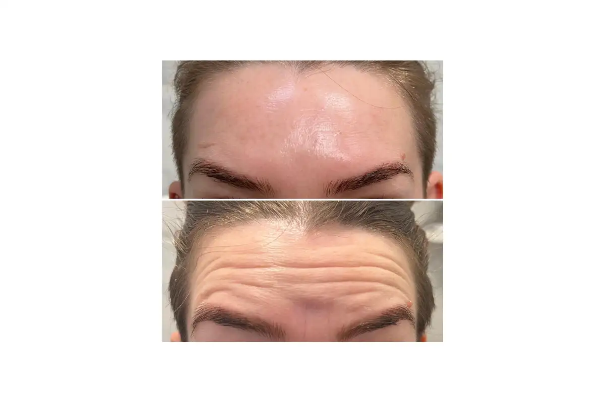 کاربردهای اصلی بوتاکس