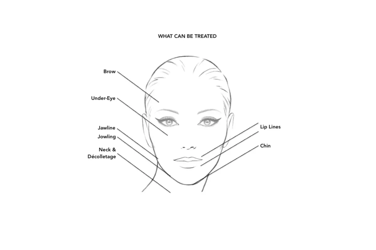 کاربردها و نواحی قابل درمان با اندولیفت