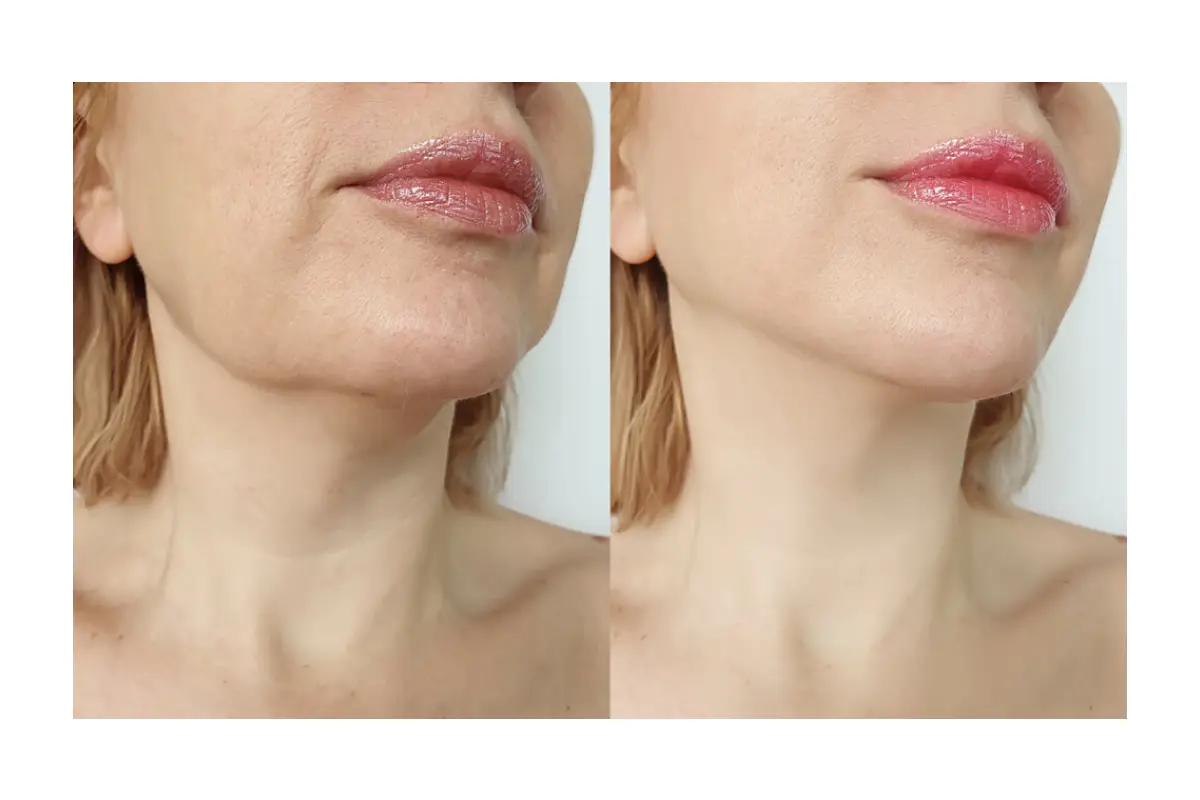 مشاهده عکس و فیلم قبل و بعد اندولیفت