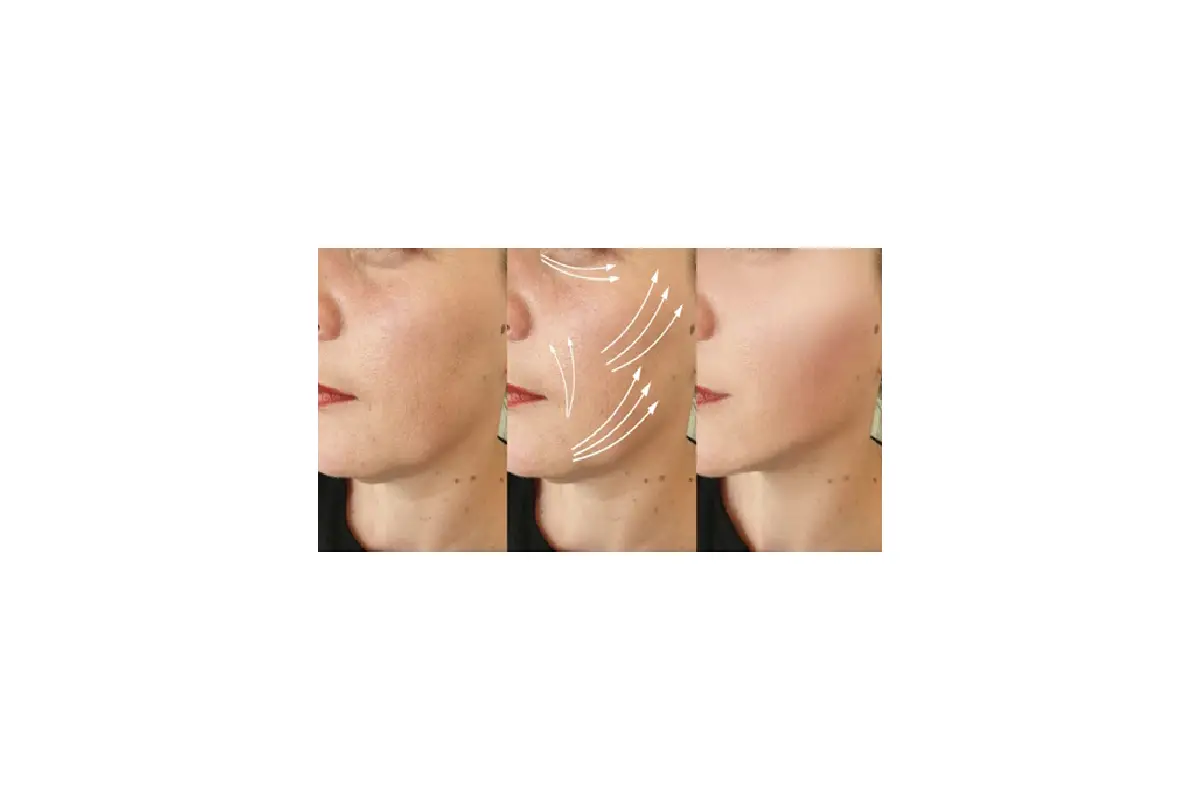 مراحل انجام اندولیفت و تعداد جلسات