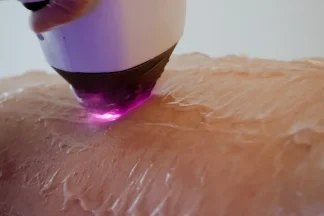 آمادگی های ضروری قبل از جلسه اول لیزر موهای زائد